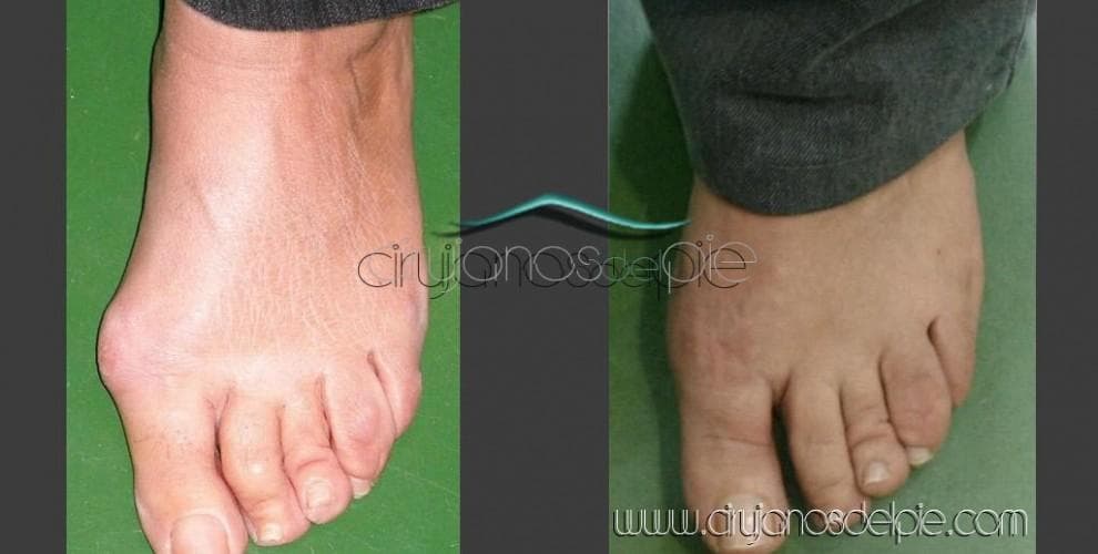 Hallux Valgus - Fall 1