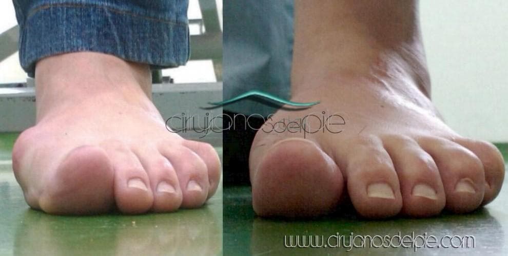 Hallux Valgus - Fall 2