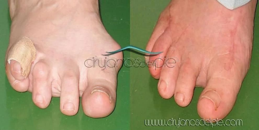 Rheumatoid Arthritis - Case 1