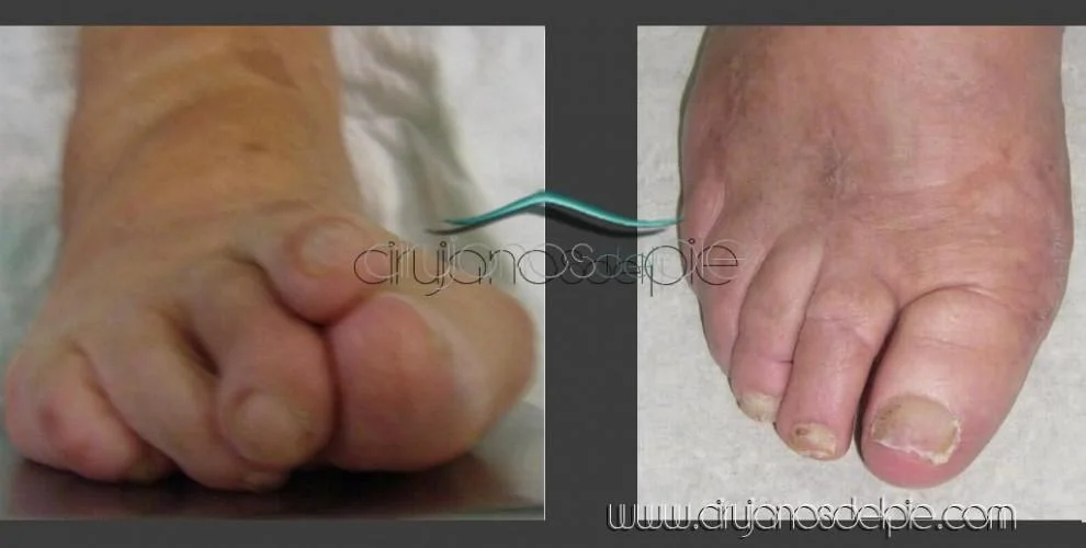 Artrite Reumatoide - Caso 2
