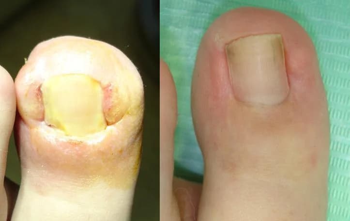 Ingrown Toenail
